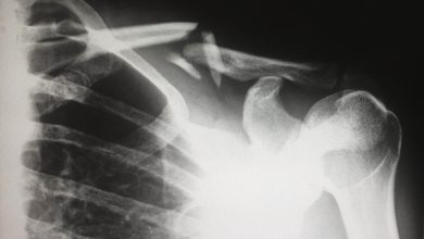 Photo of CBD für deine Knochen (Osteoporose)